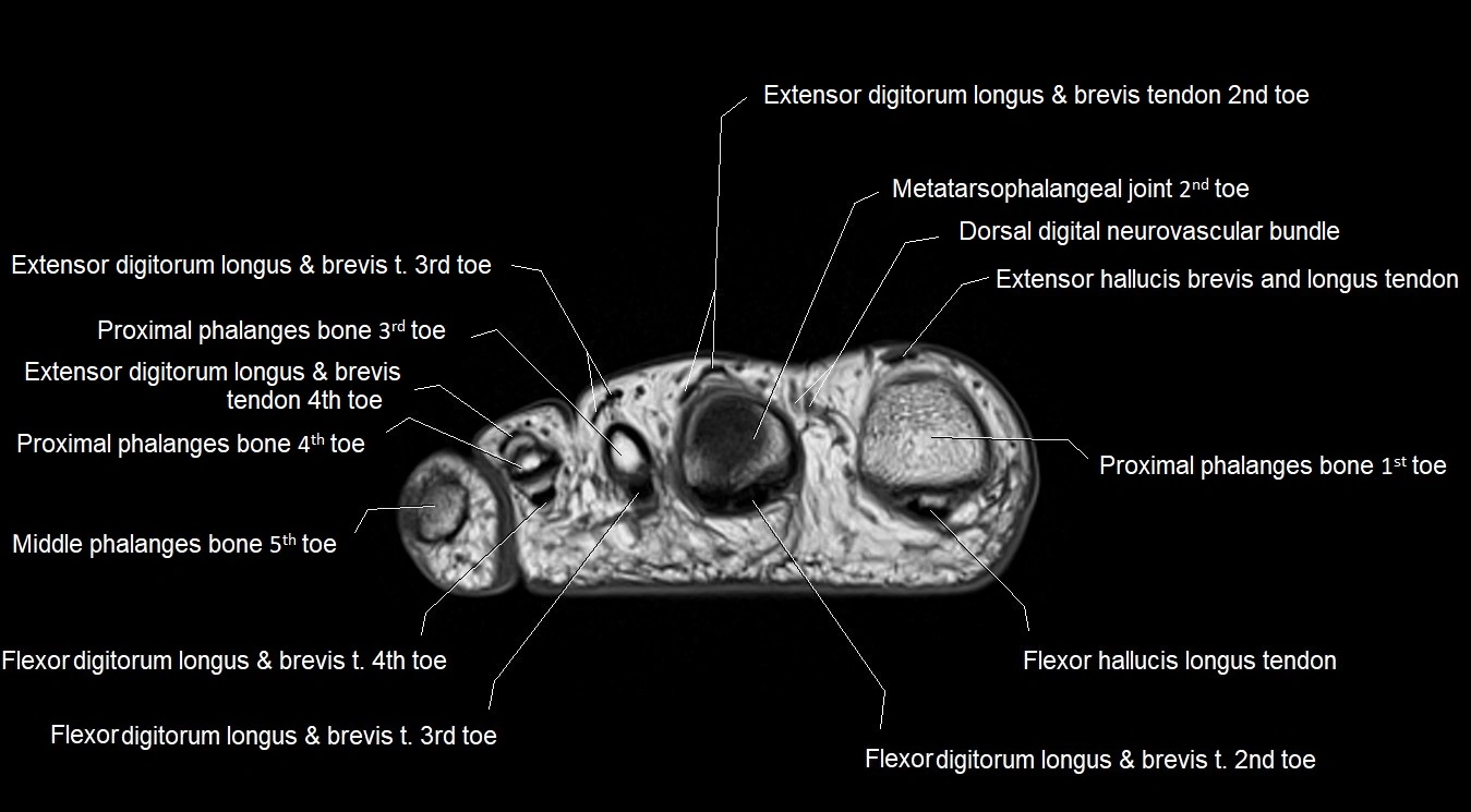 MRI 3T foot axial cross sectional anatomy image 31.webp